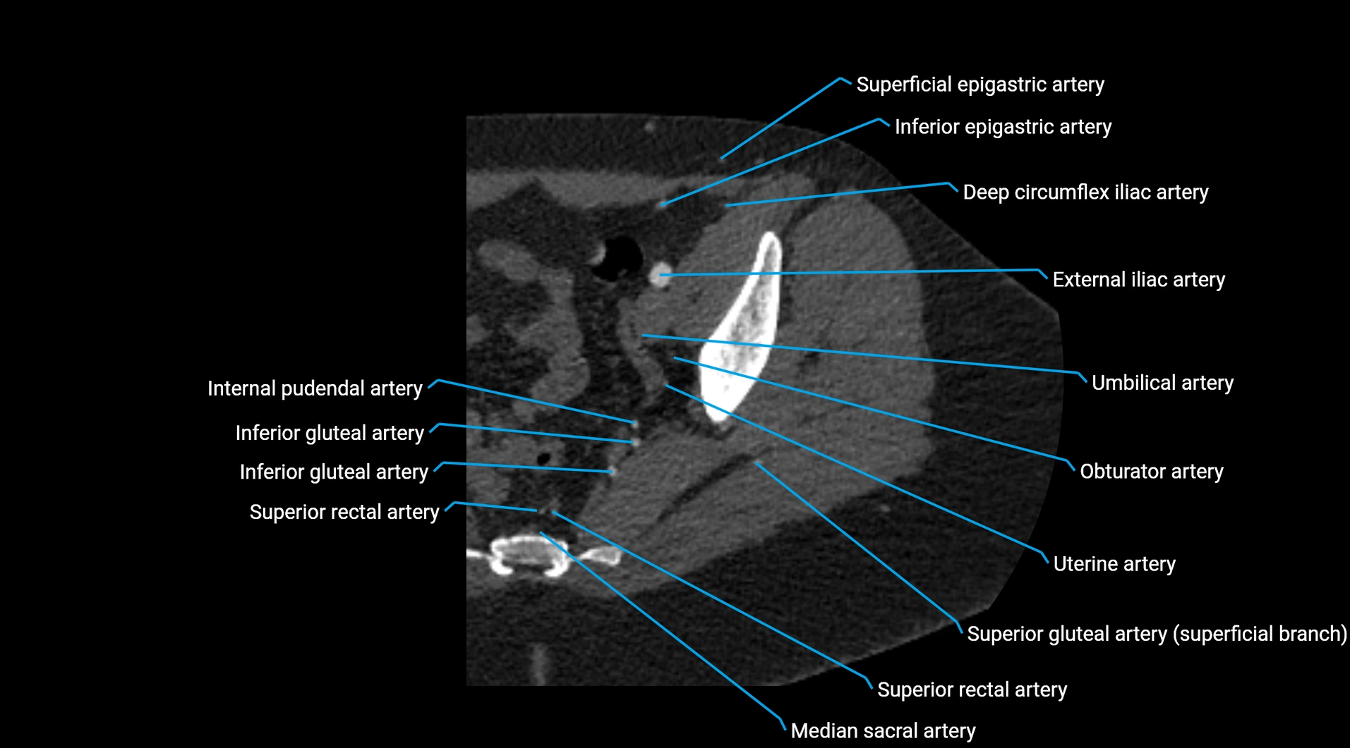 CTA lower limb cross sectional anatomy labelled image _40.webp